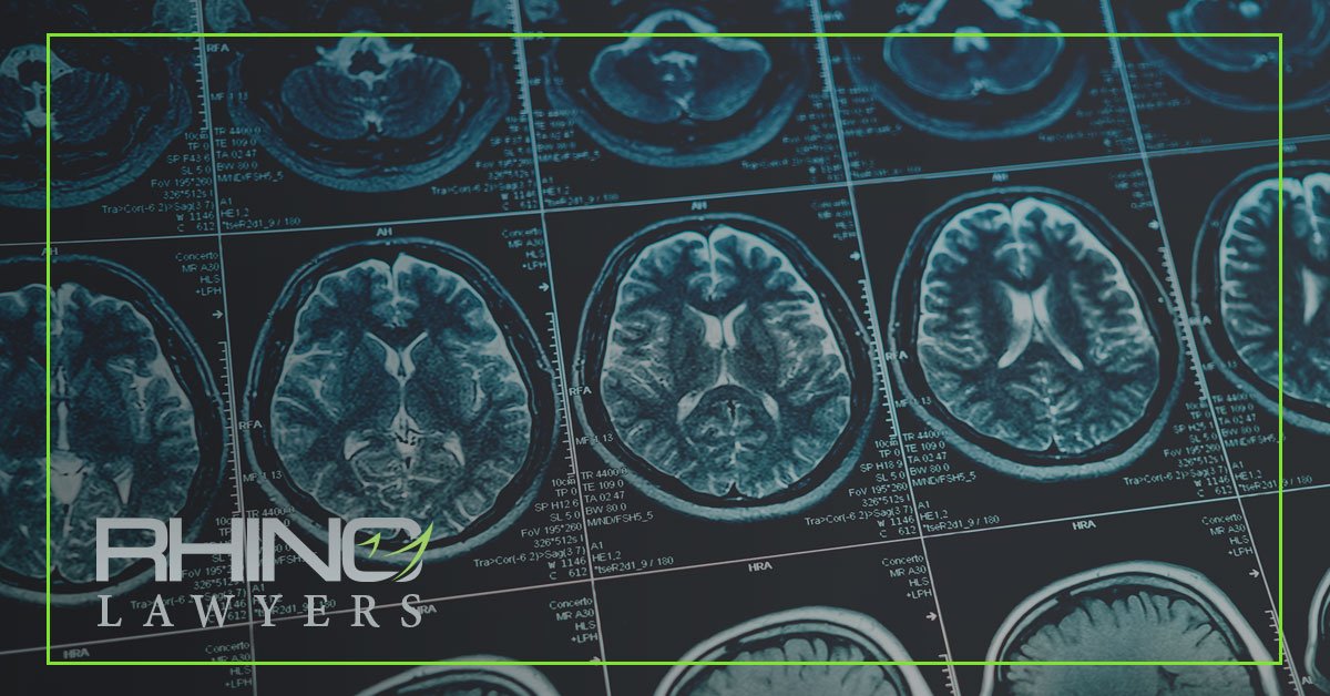 ¿Qué son las lesiones cerebrales por golpe y por contusión?