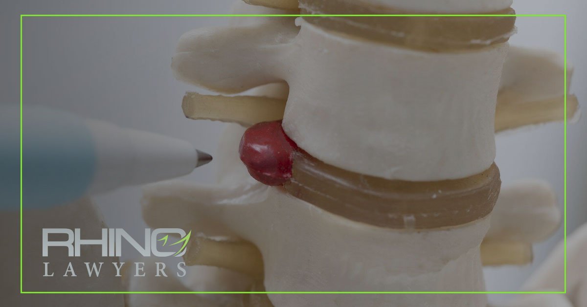 ¿Por qué son frecuentes las hernias discales tras un accidente de tráfico?